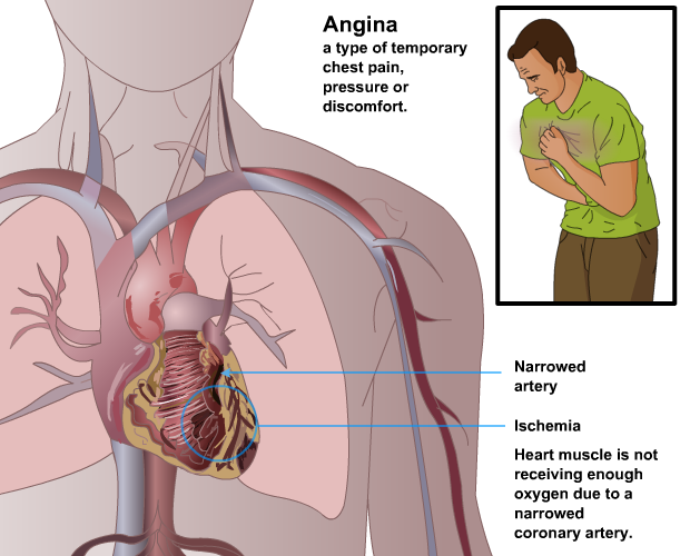 Angina Pectoris